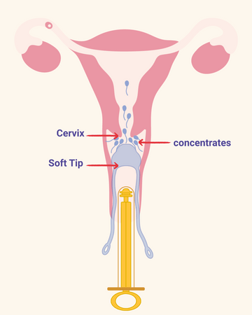 concentrate_sperm_near_cervix.png